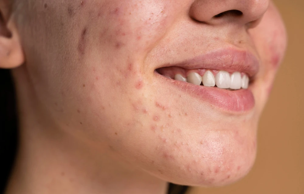 Tratamento de Cicatrizes de Acne: Transforme Sua Pele com a Dra. Raniele Gomes em São Benedito